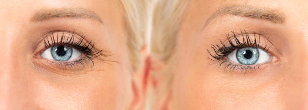 Visible improvement in fine lines around the eyes after Sculptra treatment.