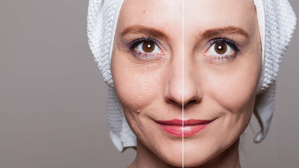 A comparison showing the transformation of a woman's skin before and after laser treatments.