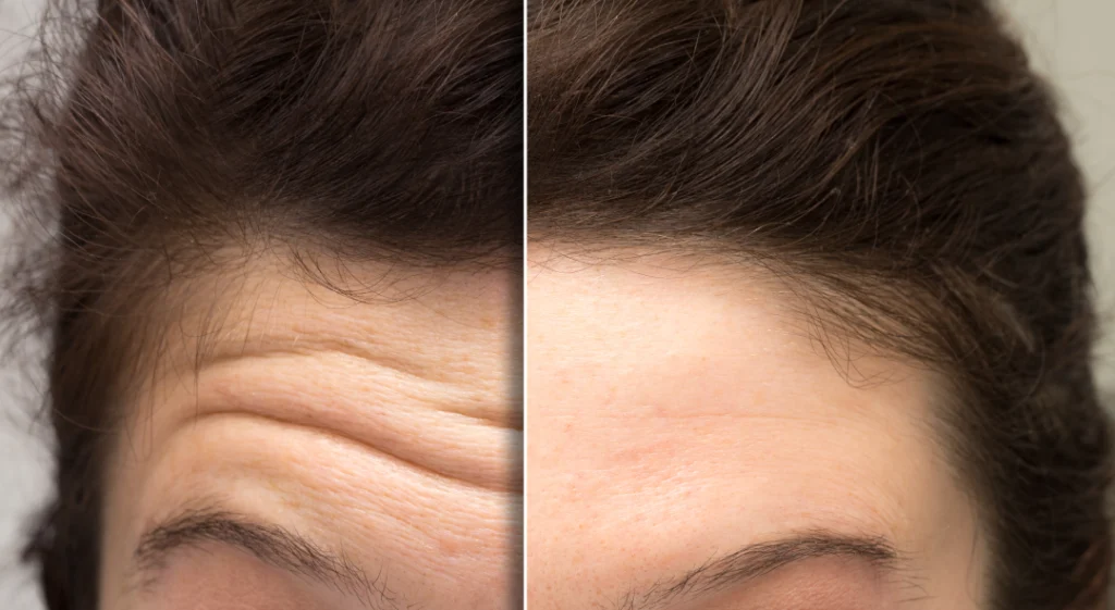 A close-up comparison of a forehead before and after Dysport treatment, showing reduced wrinkles.