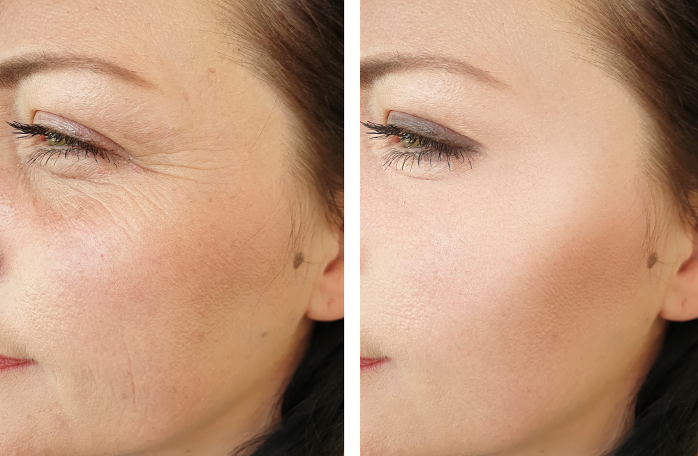 Microneedling before and after results on crow's feet area.