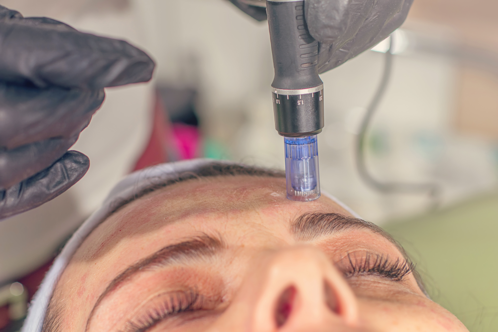 Microneedling session being performed on forehead with precision tool.